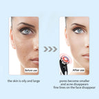 Skin Rejuvenation Facial Massager